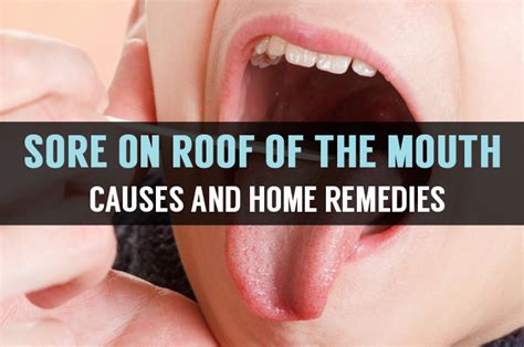 What is Roof of the Mouth Sore? Know its Causes & Remedies