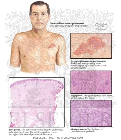 Dermatofibrosarcoma Protuberans