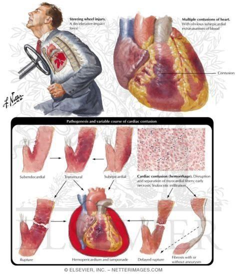 Can the heart itself be damaged by an external force, such as being struck forcefully in the ...