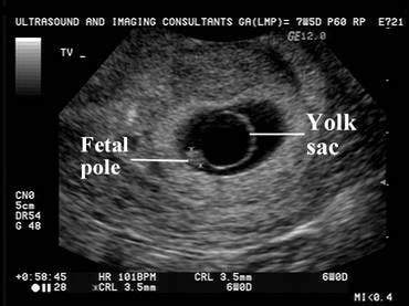 Abnormalities of the Yolk Sac | Diagnostic medical sonography, Ultrasound technician, Ultrasound ...