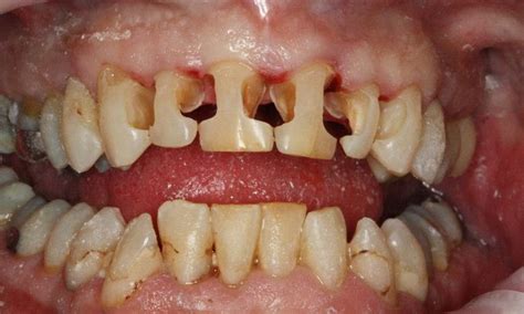 Before & After Photos | Tooth-Colored Fillings Gallery | Lead SD