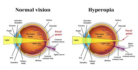 Farsightedness, Causes, Symptoms, Diagnosis, Treatment - Rxharun