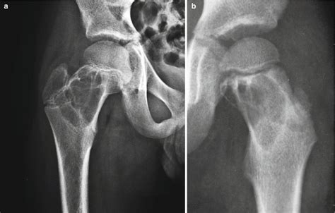 Simple Bone Cyst | Musculoskeletal Key