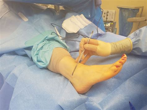 Surgical Repair of Peroneal Tendon Tear | Foot and Ankle Associates of ...