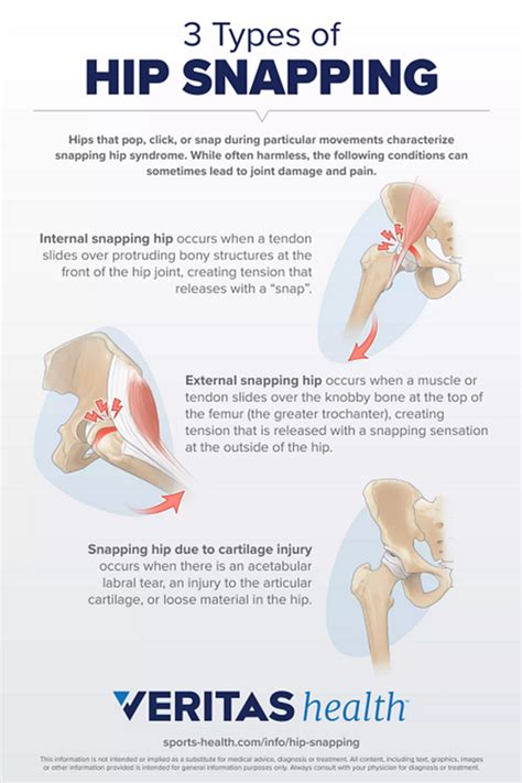 3 Types of Snapping Hip Syndrome | Sports-health