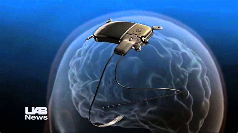 UAB implants responsive neurostimulator for epilepsy seizure control ...