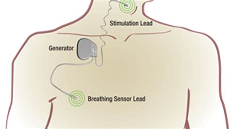 First FDA-approved implant for sleep apnea patients created in Minnesota | FOX 9 Minneapolis-St ...