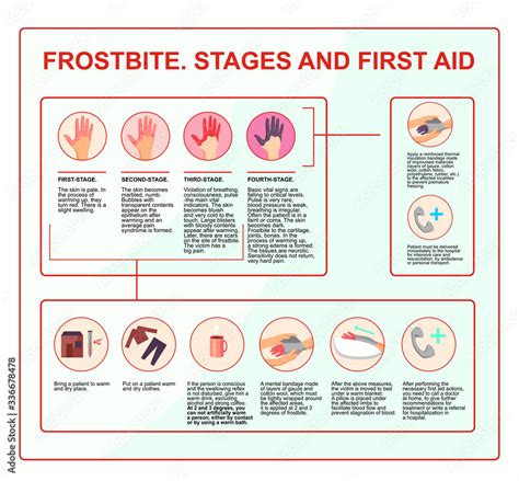 Frostbite - symptoms, protection and treatment. infographics ...