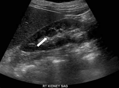 CEUS Excludes Kidney Mass - International Contrast Ultrasound Society