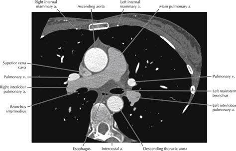 Cardiac Anatomy Using CT | Radiology Key