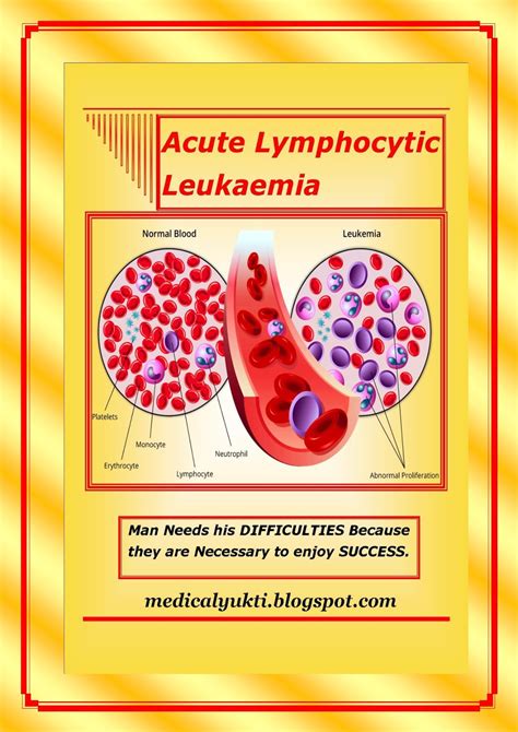 Acute Lymphocytic Leukaemia - Medical Yukti