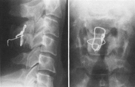 Posterior cervical interspinous compression wiring and fusion for mid to low cervical spinal ...