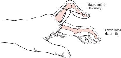 boutonnieres vs swan necking - Google Search | Hand therapy, Deformed, Neck