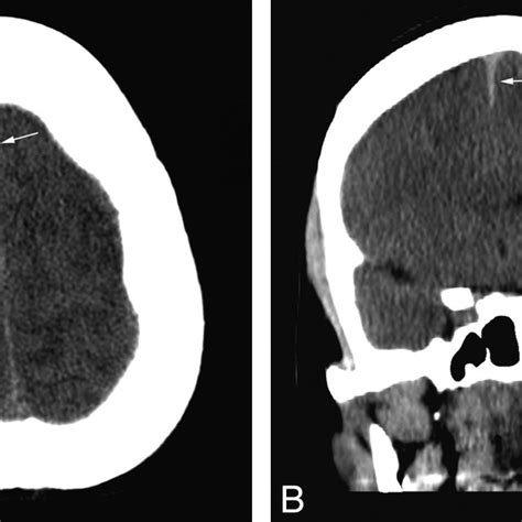 A, Minimal thickening of the anterior falx (arrow ) is not... | Download Scientific Diagram