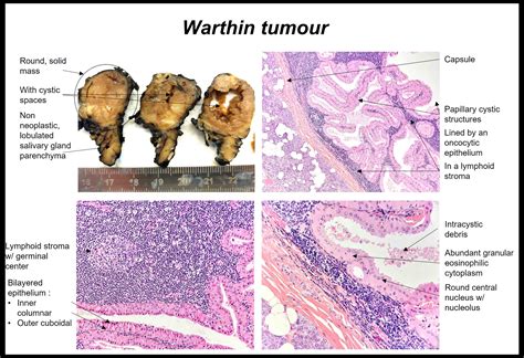 Pathology Outlines - Warthin tumor