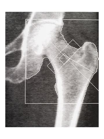 Bone Density Medical Scan Hip Osteoporosis Diagnosis Stock Photo - Download Image Now - iStock