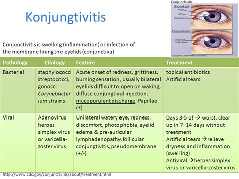 Conjunctivitis treatment antibiotic eye drops