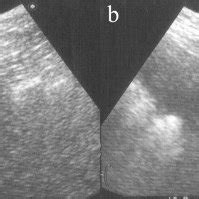 US examination. (a) Horizontal scan. A subcutaneous cyst (white arrow)... | Download Scientific ...