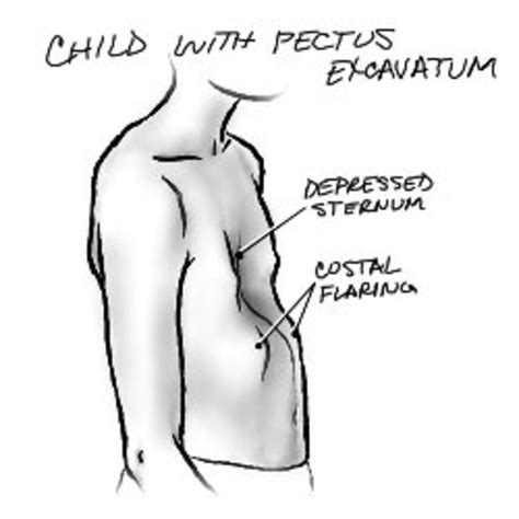 What Is Pectus Excavatum? Growing Up With PE, Causes, Surgery, and Exercise - HubPages