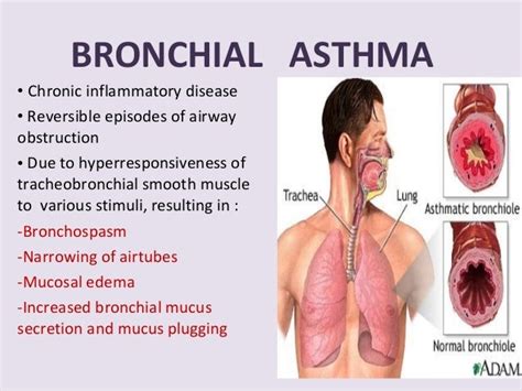 19.bronchial asthma