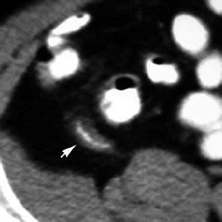 (PDF) Rapid CT scan visualization of the appendix and early acute non ...