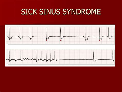 PPT - MALIGNANT ARRHYTHMIAS: ECG IDENTIFICATION PowerPoint Presentation ...