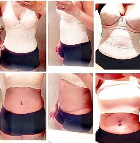 Before and after tummy tuck in Kansas city » Tummy Tuck: Prices, Photos, Reviews, Info, Q&A