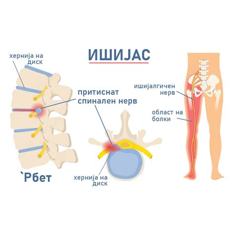 Ишијас - интезивна болка во половината - Slavej