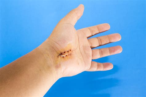 What to Expect When Recovering From Hand Surgery | The Orthopaedic Center