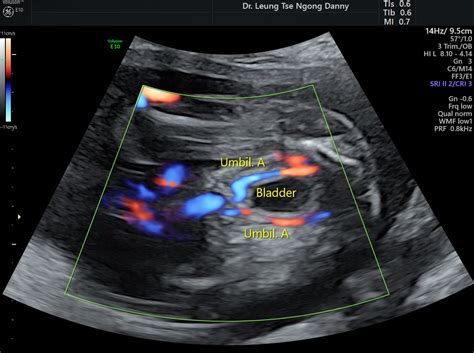 Umbilical Artery Ultrasound