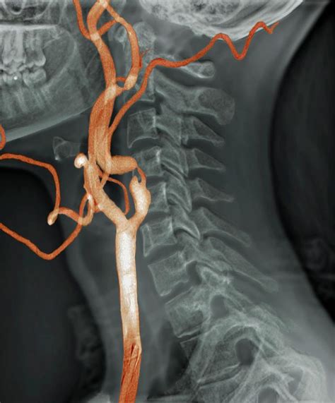 Stenosis Of Carotid Artery Photograph by Zephyr/science Photo Library ...