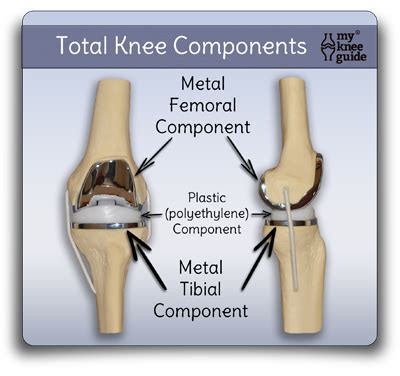 Pin on My Knee Guide - Knee Replacement (Images)