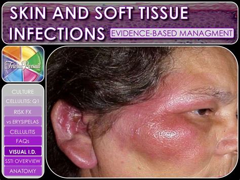 Skin and Soft Tissue Infections