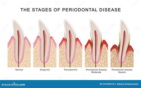 The Stages of Periodontal Disease Stock Illustration - Illustration of canine, connective: 241569318