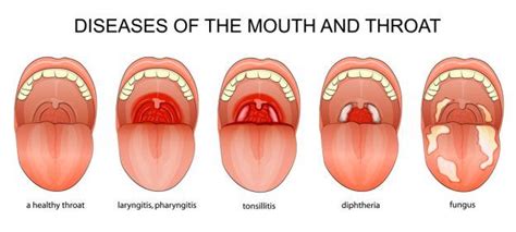 what causes sore throat - Jasmine Hill