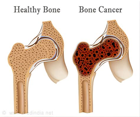 Bone Cancer(sarcoma) - Purwanchal Cancer Hospital