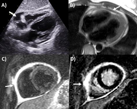 Multi-Modality Cardiac Imaging for Pericardial Diseases: A Contemporary Review