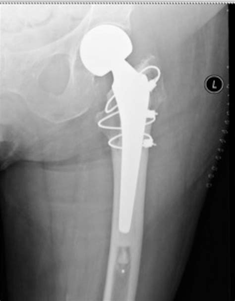 Early Complications Following Cemented Modular Hip Hemiarthroplasty