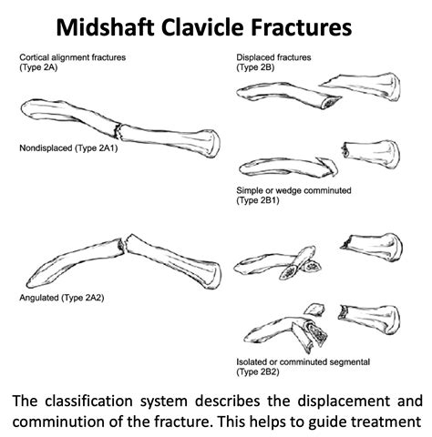 Clavicle Fracture Classification