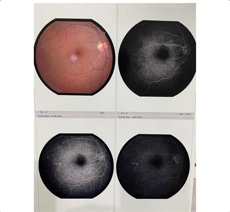 Fundus fluorescein angiography of the right eye | Download Scientific Diagram