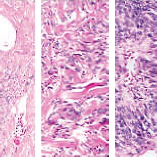 4 Hamartoma. Histology showing respiratory epithelium lined by... | Download Scientific Diagram