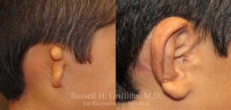 Microtia Surgery - Russell H. Griffiths, MD