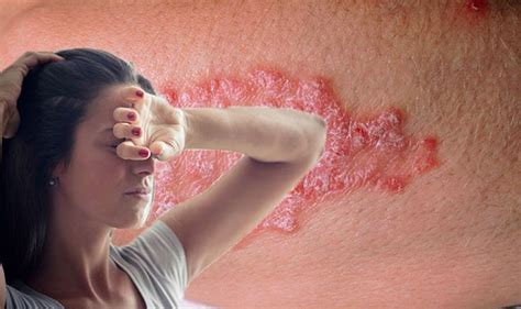 Psoriasis: Five tips to prevent flare-ups and treat the skin condition ...