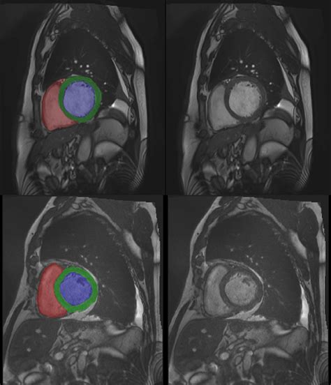 3D Cardiac MRI automatic segmentation by RSIP Vision