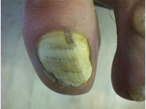 SUPERFICIAL FUNGAL INFECTIONS - Superficial white onychomycosis picture | Hellenic ...