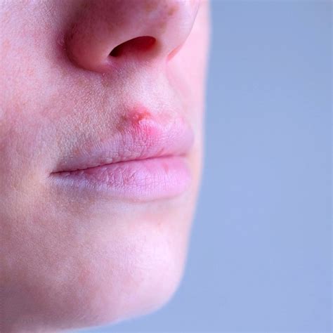 Why Are Cold Sores On Lips | Lipstutorial.org