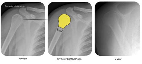 Shoulder Dislocation – OrthoSHO