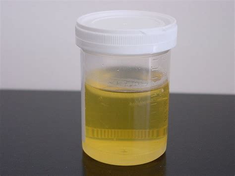 Primary Health Station: Cloudy & Foamy Urine: Is It Proteinuria?