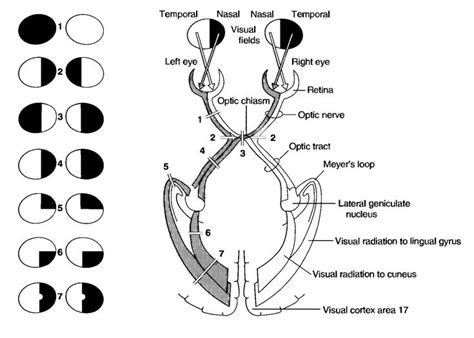 heathnapx - left homonymous superior quadrantanopia | Medical school studying, Eye retina ...