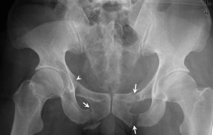 The digital radiograph of fractured pelvis of a 45-year | Open-i